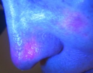 Aktinische Keratosen an der Nase und der Wange, sichtbar gemacht mit photodynamischer Diagnostik Aktinische Keratosen an der Nase und der Wange, sichtbar gemacht mit photodynamischer Diagnostik