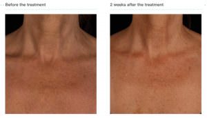 Bessere Hautqualität im Decollte nach einer Behandlung mit Juvederm Volite Bessere Hautqualität im Decollte nach einer Behandlung mit Juvederm Volite
