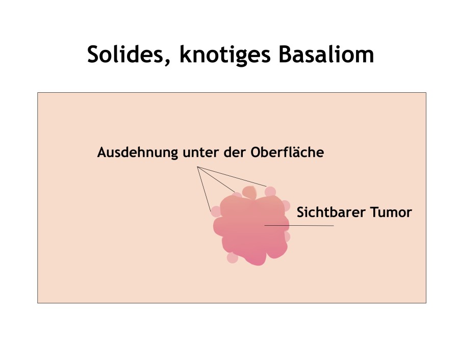 Knotiges Basaliom Mainz