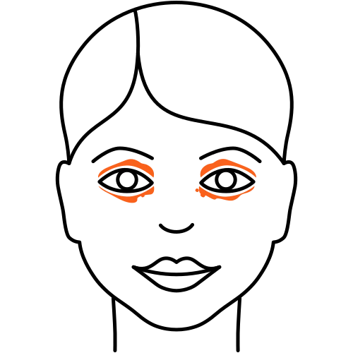 Xanthelasma