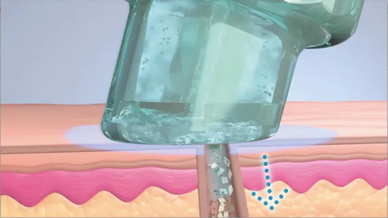 Hydrafacial Behandlung in Mainz
