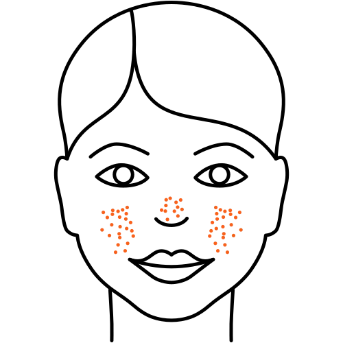 Hautporen verkleinern (Kosmetische Medizin)