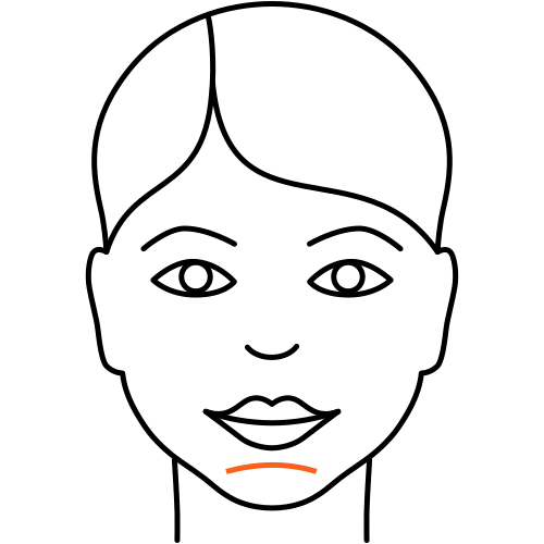 Kinnfalten unterspritzen (Kosmetische Medizin)