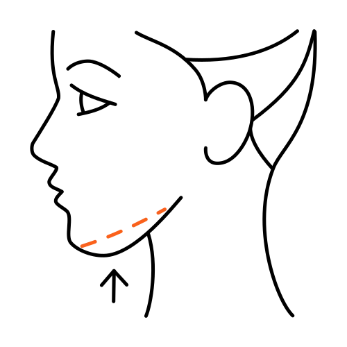 Lipolyse - Fettreduktion ohne Operation (Kosmetische Medizin)