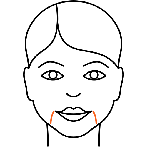 Marionettenfalten unterspritzen (Kosmetische Medizin)