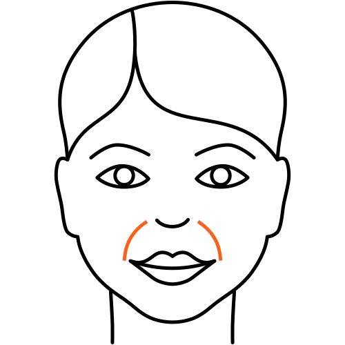 Nasolabialfalte unterspritzen (Kosmetische Medizin)