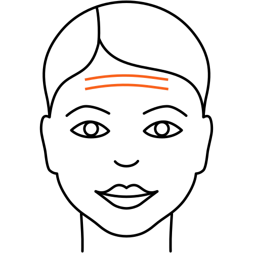 Stirnfalten unterspritzen (Kosmetische Medizin)