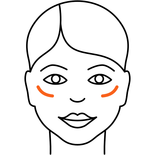 Wangen auffüllen (Kosmetische Medizin)